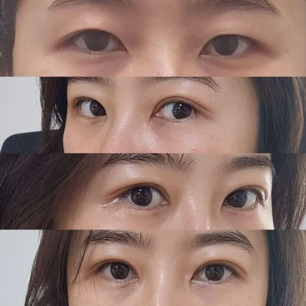 自然癒着法, 目つき矯正 — RE&RE PLASTIC SURGERY 6