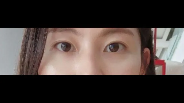 Natural Adhesion Double Eyelid Surgery, Ptosis Correction — RE&RE PLASTIC SURGERY 2