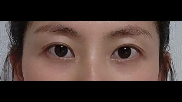 Natural Adhesion Double Eyelid Surgery, Ptosis Correction — RE&RE PLASTIC SURGERY 3
