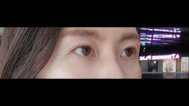 Natural Adhesion Double Eyelid Surgery, Ptosis Correction — RE&RE PLASTIC SURGERY 4