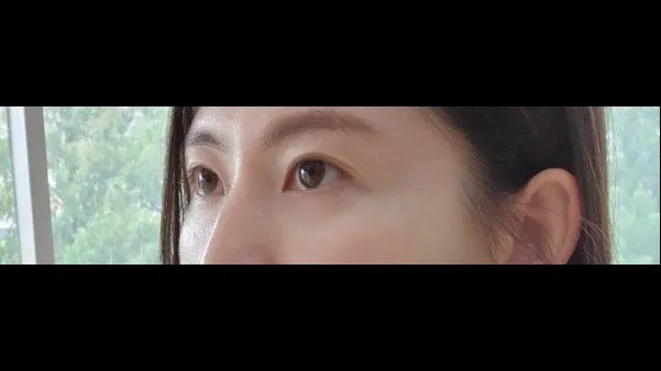 Natural Adhesion Double Eyelid Surgery, Ptosis Correction — RE&RE PLASTIC SURGERY 5