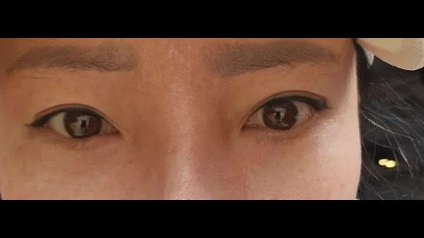 Sub-brow Lift, Lower Eyelid Fat Grafting — RE&RE PLASTIC SURGERY 2