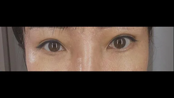 Sub-brow Lift, Lower Eyelid Fat Grafting — RE&RE PLASTIC SURGERY 3