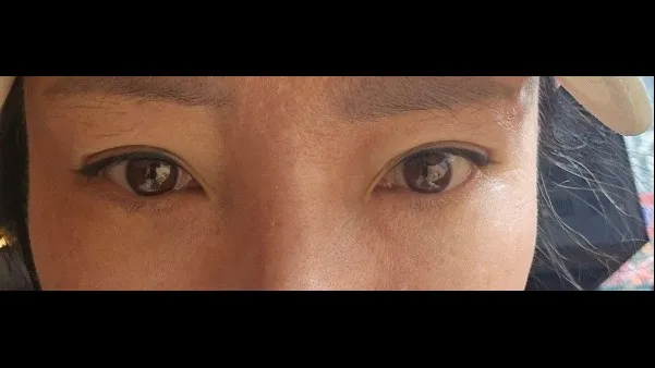 Sub-brow Lift, Lower Eyelid Fat Grafting — RE&RE PLASTIC SURGERY 5