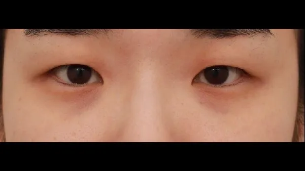 Incisional Double Eyelid Surgery, Ptosis Correction, Lower Eyelid Fat Repositioning, Lower Eyelid Fat Grafting, Midface Lift 1