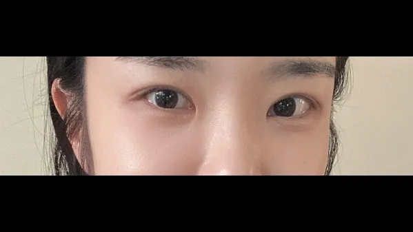 Incisional Double Eyelid Surgery, Ptosis Correction, Lower Eyelid Fat Repositioning, Lower Eyelid Fat Grafting, Midface Lift — RE&RE PLASTIC SURGERY 2