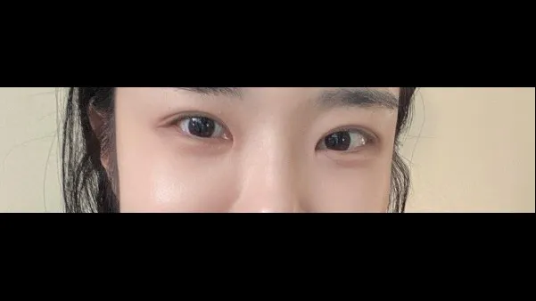 Incisional Double Eyelid Surgery, Ptosis Correction, Lower Eyelid Fat Repositioning, Lower Eyelid Fat Grafting, Midface Lift — RE&RE PLASTIC SURGERY 3