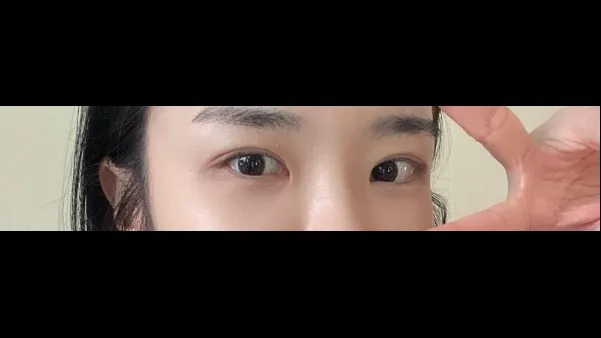 Incisional Double Eyelid Surgery, Ptosis Correction, Lower Eyelid Fat Repositioning, Lower Eyelid Fat Grafting, Midface Lift — RE&RE PLASTIC SURGERY 4