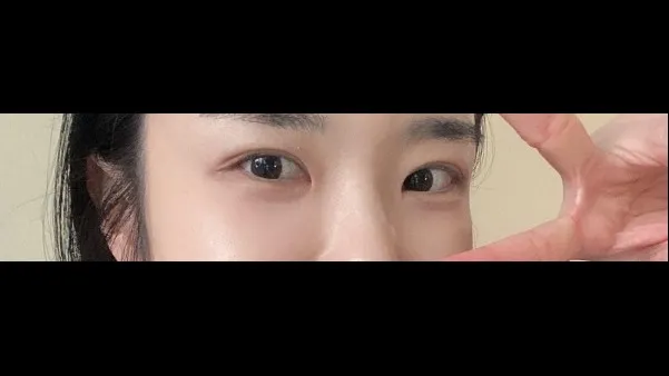 Incisional Double Eyelid Surgery, Ptosis Correction, Lower Eyelid Fat Repositioning, Lower Eyelid Fat Grafting, Midface Lift — RE&RE PLASTIC SURGERY 5
