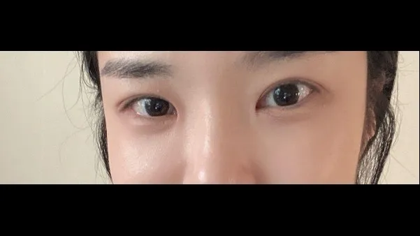 Incisional Double Eyelid Surgery, Ptosis Correction, Lower Eyelid Fat Repositioning, Lower Eyelid Fat Grafting, Midface Lift — RE&RE PLASTIC SURGERY 6