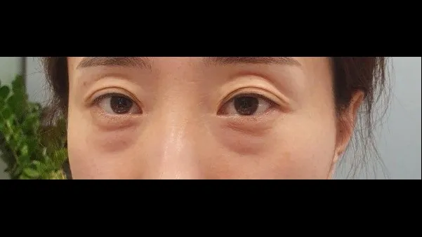 Lower Blepharoplasty (Aging Eye Rejuvenation), Lower Eyelid Fat Grafting — RE&RE PLASTIC SURGERY 1