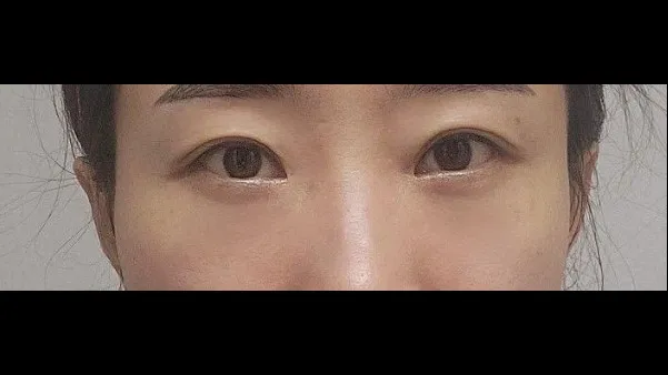 Lower Blepharoplasty (Aging Eye Rejuvenation), Lower Eyelid Fat Grafting 2