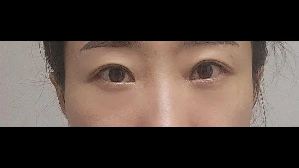 Lower Blepharoplasty (Aging Eye Rejuvenation), Lower Eyelid Fat Grafting — RE&RE PLASTIC SURGERY 3