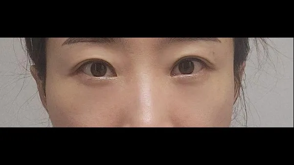 Lower Blepharoplasty (Aging Eye Rejuvenation), Lower Eyelid Fat Grafting — RE&RE PLASTIC SURGERY 4