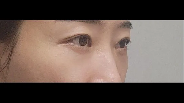 Lower Blepharoplasty (Aging Eye Rejuvenation), Lower Eyelid Fat Grafting — RE&RE PLASTIC SURGERY 5