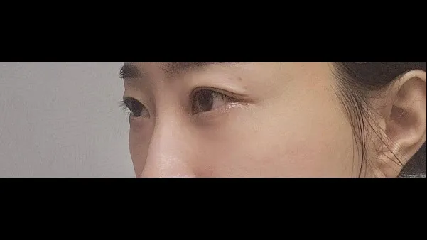 Lower Blepharoplasty (Aging Eye Rejuvenation), Lower Eyelid Fat Grafting — RE&RE PLASTIC SURGERY 6