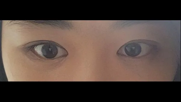 Ptosis Correction, Natural Adhesion Double Eyelid Surgery — RE&RE PLASTIC SURGERY 2