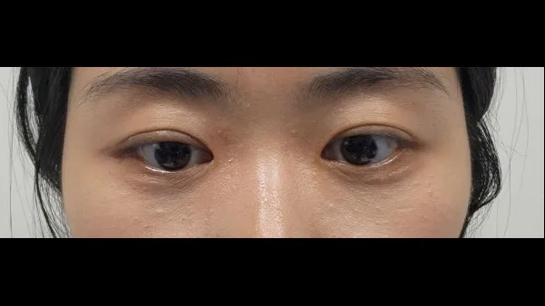 Ptosis Correction, Natural Adhesion Double Eyelid Surgery — RE&RE PLASTIC SURGERY 3