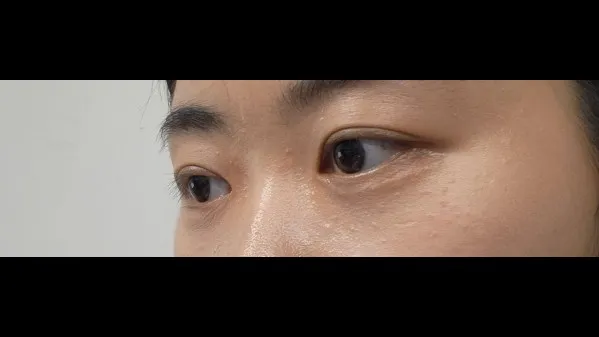 Ptosis Correction, Natural Adhesion Double Eyelid Surgery — RE&RE PLASTIC SURGERY 4