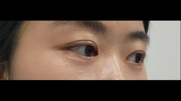 Ptosis Correction, Natural Adhesion Double Eyelid Surgery — RE&RE PLASTIC SURGERY 5