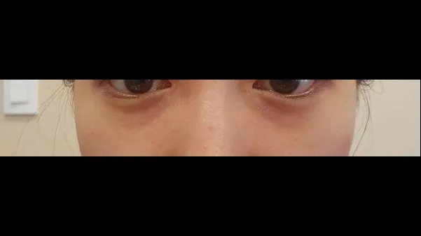 Lower Eyelid Fat Repositioning, Midface Lift 1