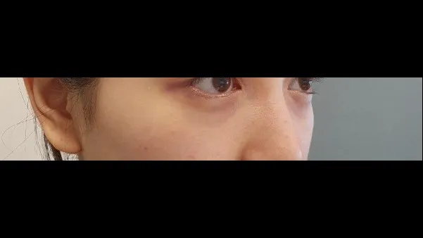 Lower Eyelid Fat Repositioning, Midface Lift 2