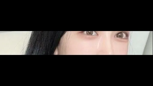 Lower Eyelid Fat Repositioning, Midface Lift — RE&RE PLASTIC SURGERY 5