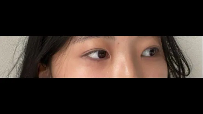 Natural Adhesion Double Eyelid Surgery, Ptosis Correction — RE&RE PLASTIC SURGERY 2