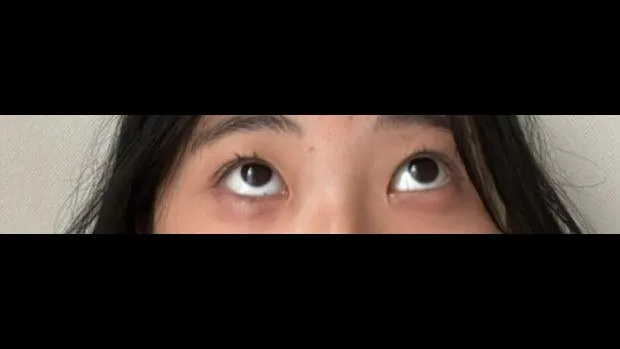 Natural Adhesion Double Eyelid Surgery, Ptosis Correction — RE&RE PLASTIC SURGERY 3