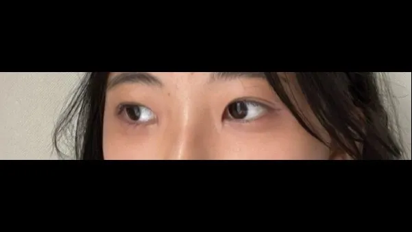 Natural Adhesion Double Eyelid Surgery, Ptosis Correction — RE&RE PLASTIC SURGERY 4