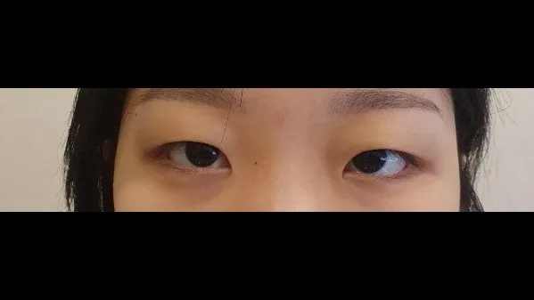 Natural Adhesion Double Eyelid Surgery 1