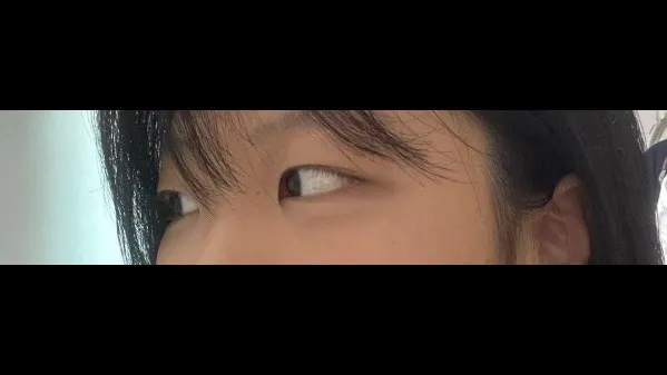Natural Adhesion Double Eyelid Surgery 2