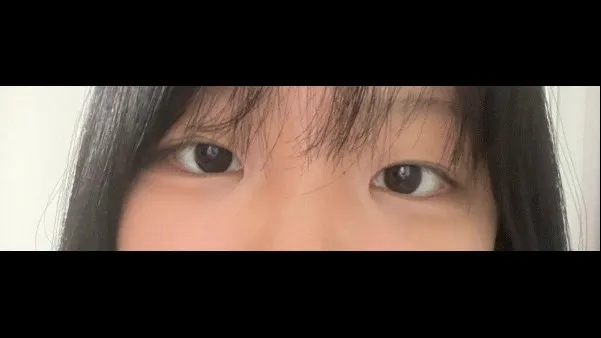 Natural Adhesion Double Eyelid Surgery — RE&RE PLASTIC SURGERY 3