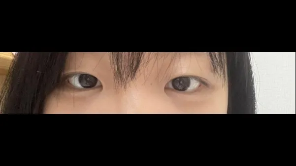 Natural Adhesion Double Eyelid Surgery — RE&RE PLASTIC SURGERY 4