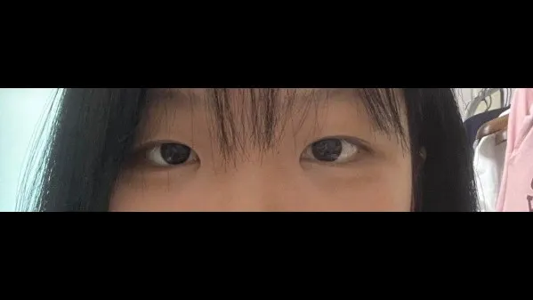 Natural Adhesion Double Eyelid Surgery — RE&RE PLASTIC SURGERY 5