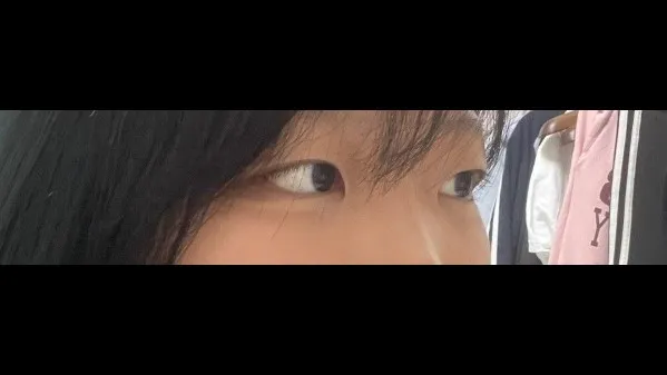 Natural Adhesion Double Eyelid Surgery — RE&RE PLASTIC SURGERY 6