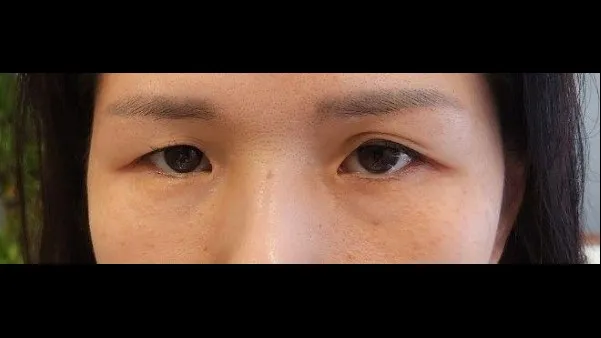 Sub-brow Lift 1
