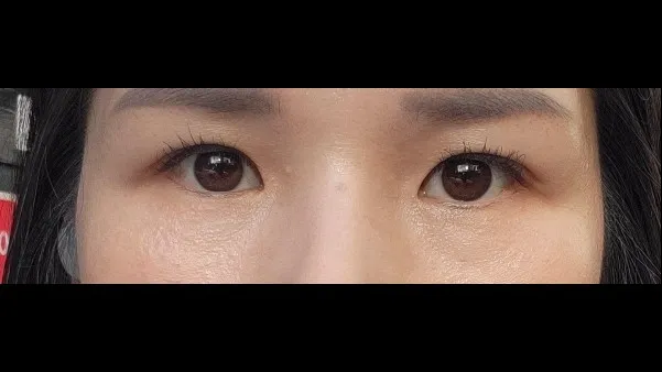Sub-brow Lift — RE&RE PLASTIC SURGERY 2