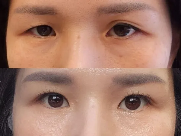 Sub-brow Lift — RE&RE PLASTIC SURGERY 3