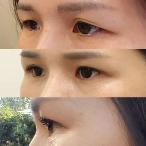 Sub-brow Lift — RE&RE PLASTIC SURGERY 4
