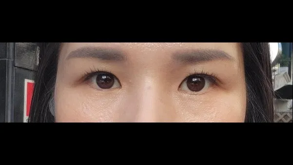 Sub-brow Lift — RE&RE PLASTIC SURGERY 5