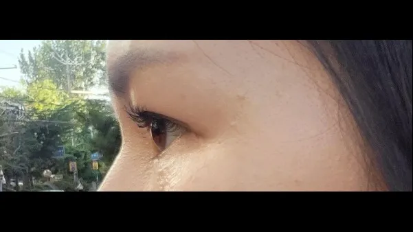 Sub-brow Lift — RE&RE PLASTIC SURGERY 6