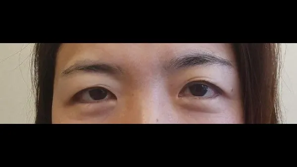 Incisional Double Eyelid Surgery 1