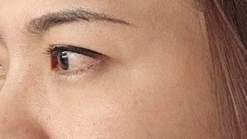 Incisional Double Eyelid Surgery — RE&RE PLASTIC SURGERY 2