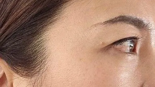 Incisional Double Eyelid Surgery — RE&RE PLASTIC SURGERY 3