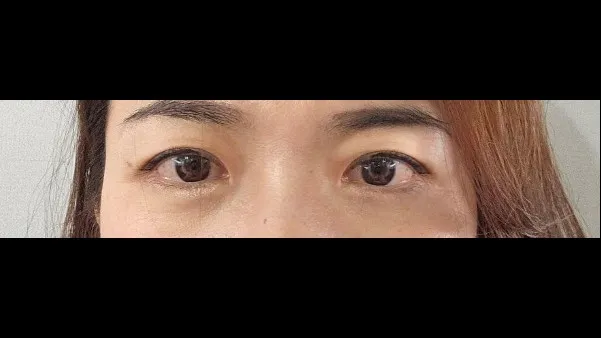 Incisional Double Eyelid Surgery — RE&RE PLASTIC SURGERY 4