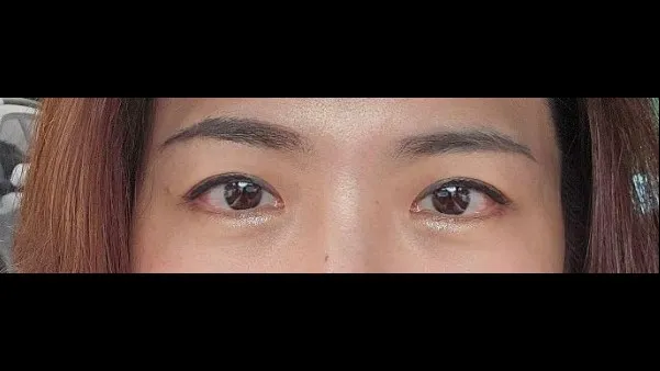 Incisional Double Eyelid Surgery — RE&RE PLASTIC SURGERY 5