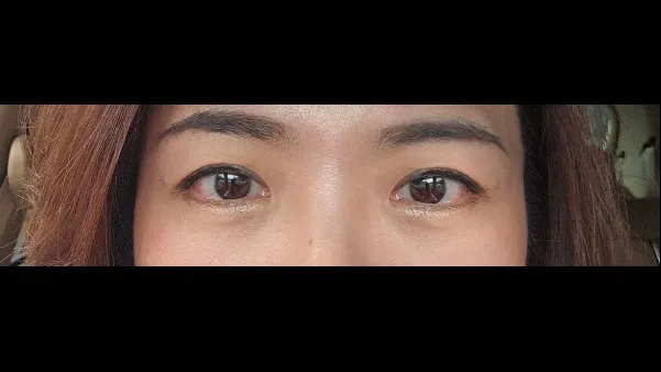 Incisional Double Eyelid Surgery — RE&RE PLASTIC SURGERY 6