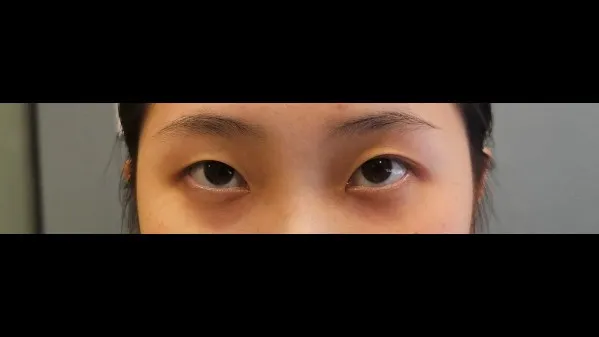 Natural Adhesion Double Eyelid Surgery, Ptosis Correction 1