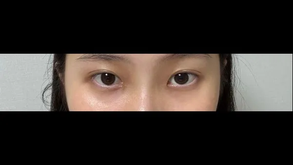 Natural Adhesion Double Eyelid Surgery, Ptosis Correction — RE&RE PLASTIC SURGERY 2